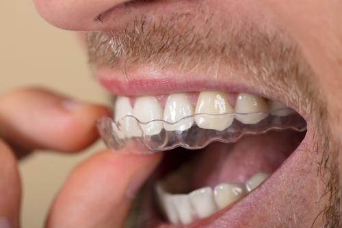 Grincement des dents : tout savoir sur le bruxisme ! – MyVariations