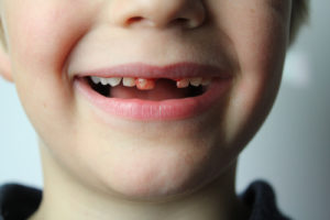 Top 10+ dent qui noircit après un choc